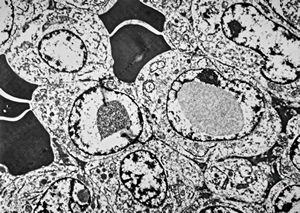 M,62y. | plasmocytoma - nasal cavity M,62y. | plasmocytoma - nasal cavity